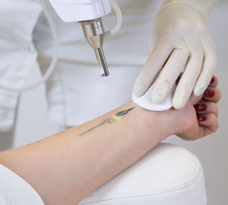 Détatouage laser