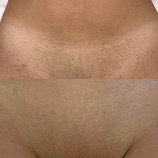Évolution d'un traitement laser, suivi 1