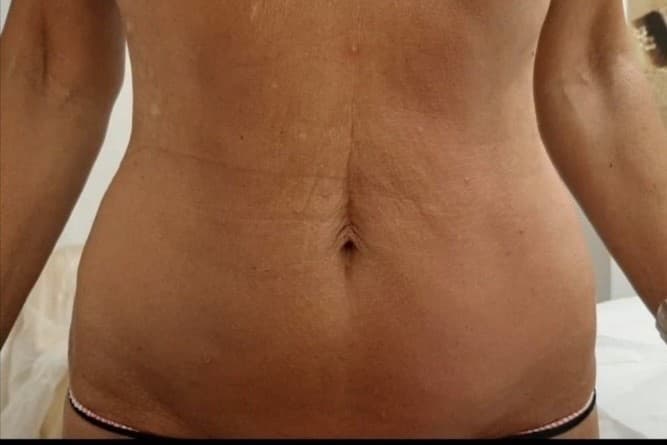 After the body contouring protocol — visibly firmer skin