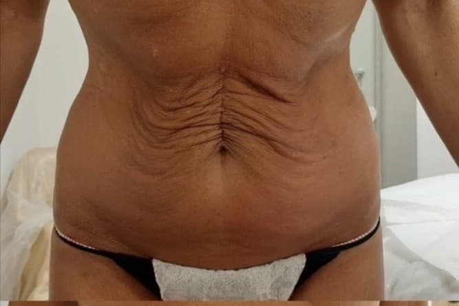 Before the body contouring protocol — loose stomach skin