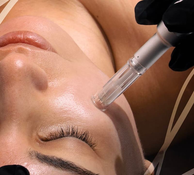 Microneedling