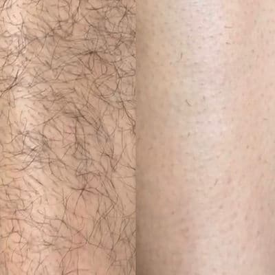 Laser treatment progress — follow-up 2