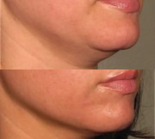 Radiofrequency