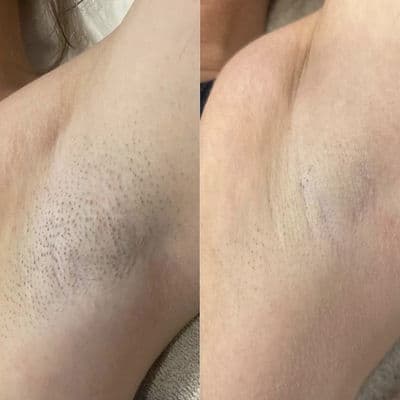 Laser treatment progress — follow-up 4